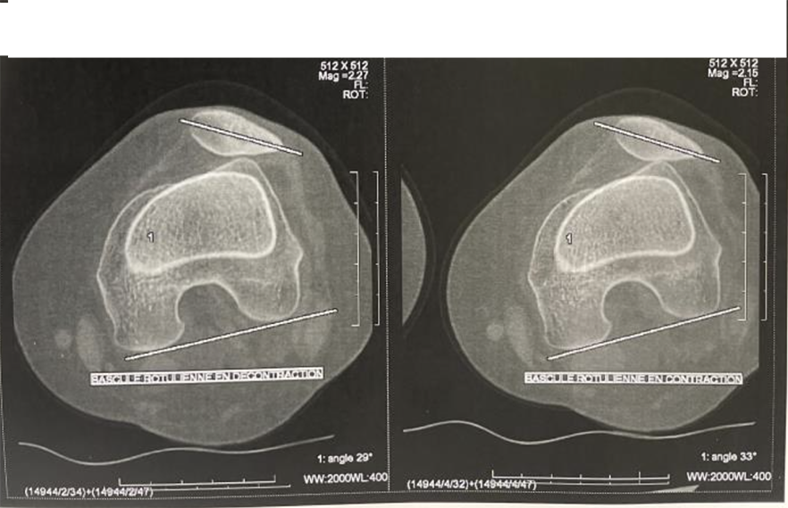 Recentrage de la rotule (Ostéotomie de la TTA) - Dr Dumoulin