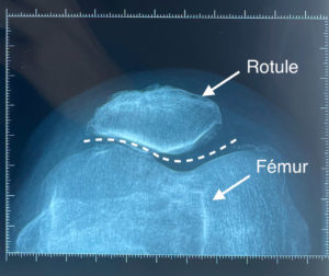 image articulation rotule fémur