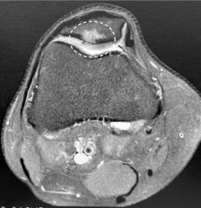 IRM rotule zone ostéochondrite
